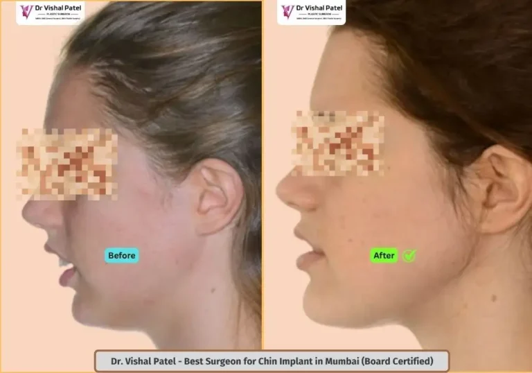 Indian Female Chin implant in Mumbai India - Before After Photo