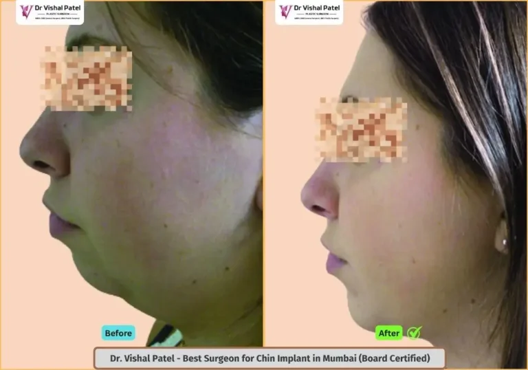 Indian Female Chin implant in Mumbai India - Before After Photo by Dr. Vishal Patel