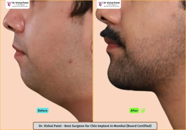 Male Chin implant in Mumbai - Before After Photo - Dr. Vishal Patel