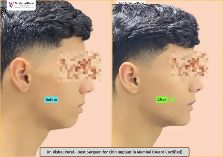 Male Chin implant in Mumbai India - Before After Photo - Indian Young Male Boy