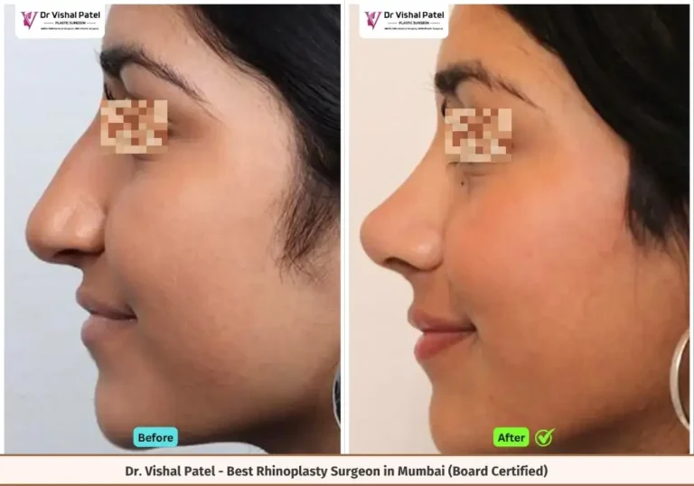 Nasal Tip Lifting Before And After - Tipplasty by Dr. Vishal Patel