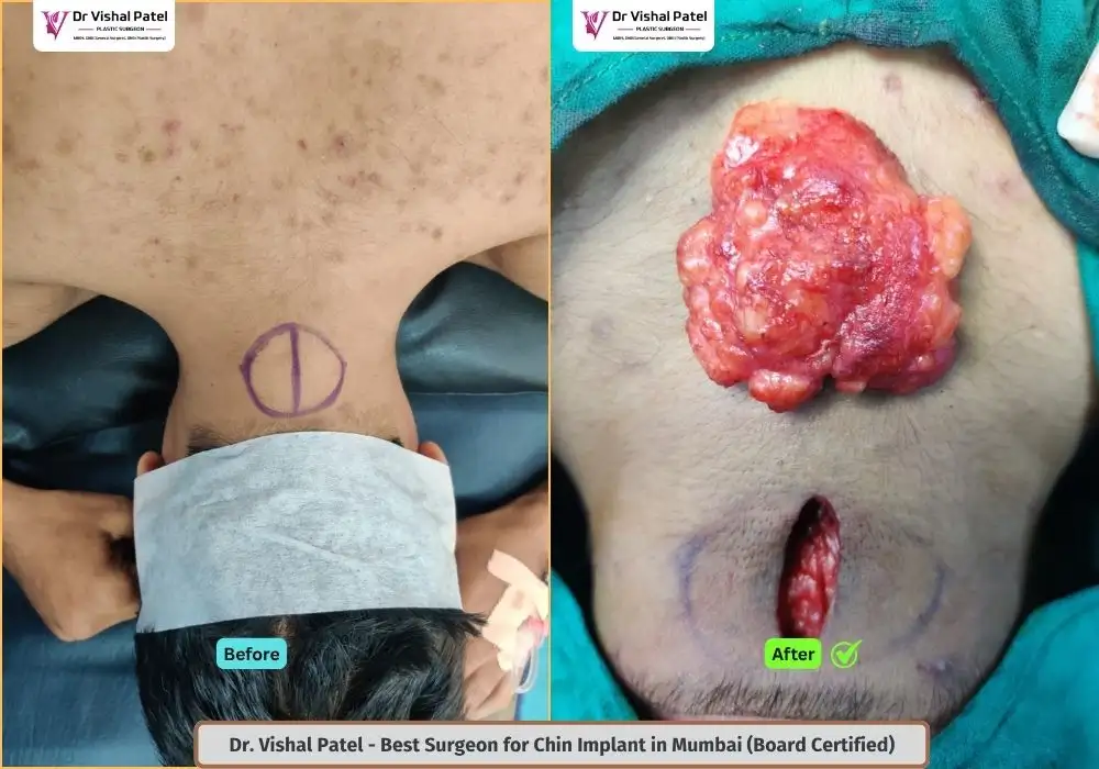 Neck Lipoma Removal in Mumbai - By Dr. Vishal Patel