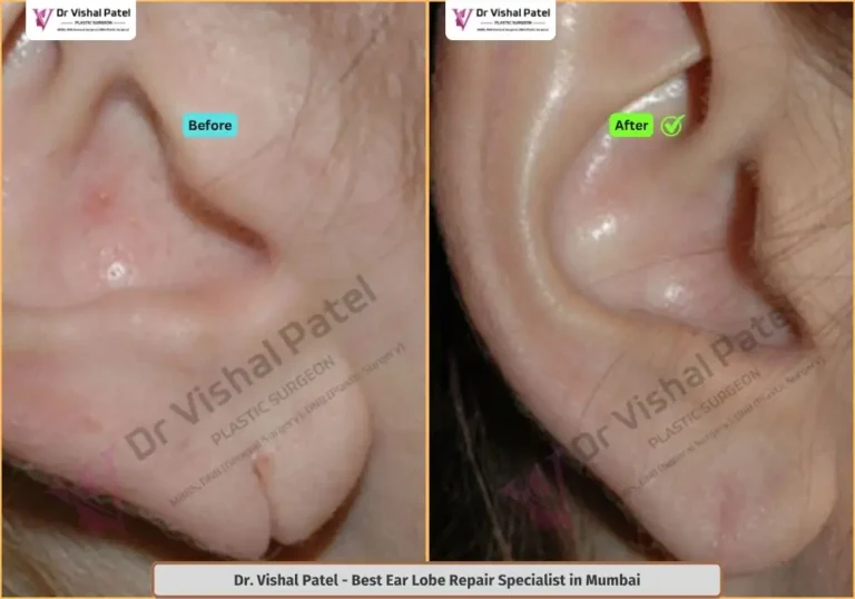 Split Ear Lobe Repair in Mumbai by Dr. Vishal Patel - Indian Female