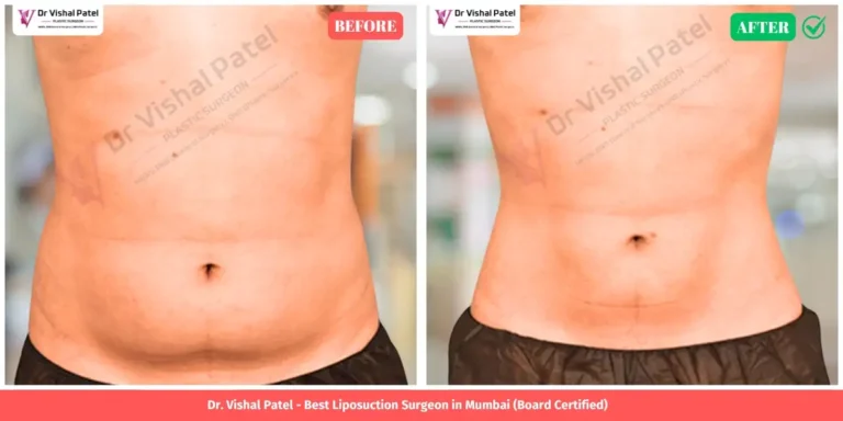 Abdomen Liposuction Before and After - Indian Male in Mumbai - Front View