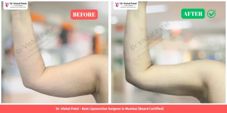 Arm Lift Arm Liposuction Before After Picture - Indian Male - Power Assisted Liposuction