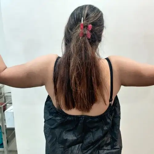 Arm Liposuction Before After Photo In India Mumbai - By Dr Vishal Patel
