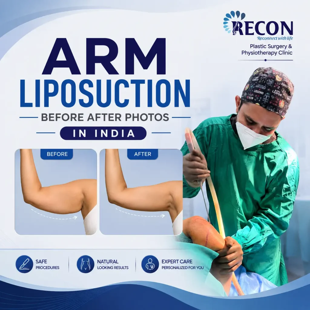 Arm Liposuction Before After Photo in Mumbai India