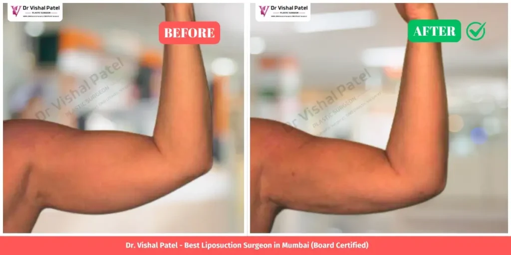 Arm Liposuction in Mumbai - Before After Photo - Indian Male from Mumbai