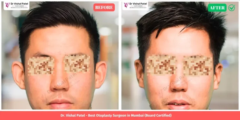 Asian Man Ear Shape Correction Before & After by Dr. Vishal Patel