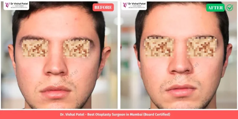 Asian Otoplasty Before & After - Asian Man by Dr. Vishal Patel