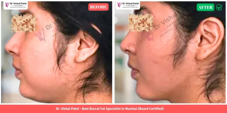 Buccal Fat Pad Removal Indian Women Before After Photo in Mumbai