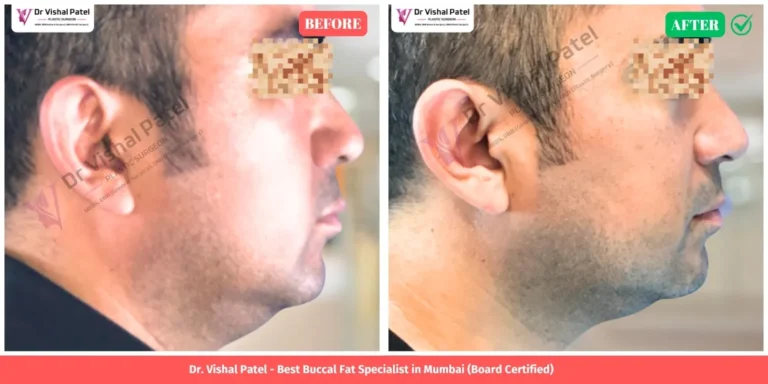 Buccal Fat Removal Surgery Before After Indian Man by Dr. Vishal Patel in Malad Mumbai