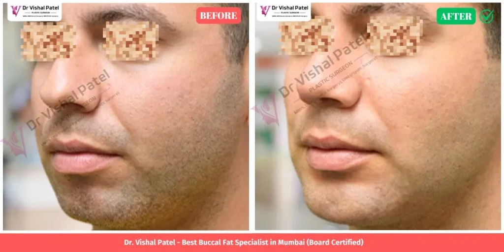 Buccal Fat Removal Surgery Before After Indian Man by Dr. Vishal Patel in Mumbai
