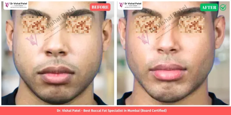 Cheek Reduction Surgery in Mumbai Before & After India