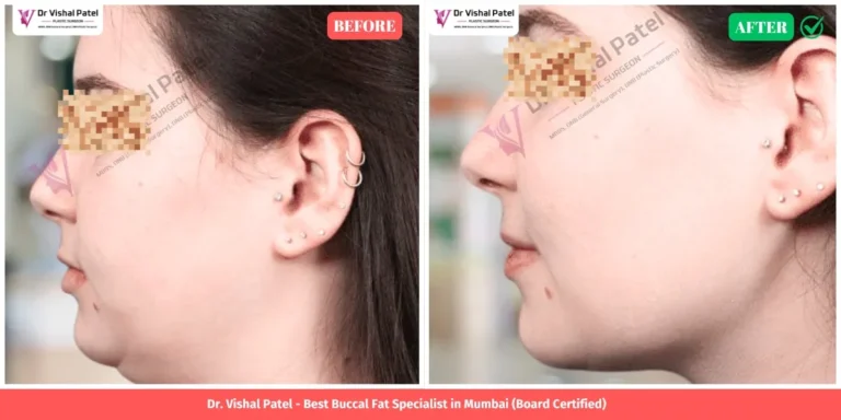Cheek fat reduction surgery in Mumbai by Dr. Vishal Patel