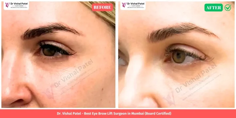 Direct Brow Lift Before and After Photo - Indian Female in Mumbai - by Dr. Vishal Patel