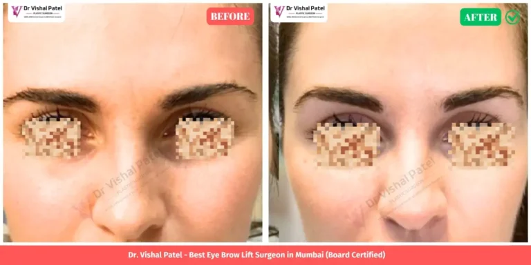 Eye Brow Lift Before and After Photo - Indian Female in Mumbai