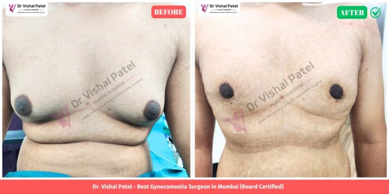 Grade 3 Gynecomastia Surgery in Mumbai - Before and After Photo - Front Chest View