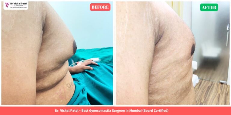 Grade 3 Gynecomastia Surgery in Mumbai - Before and After Photo - Left Chest View
