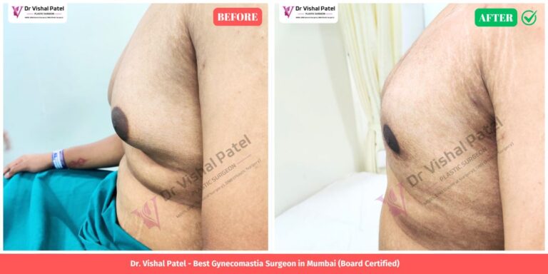 Grade 3 Gynecomastia Surgery Before After Photo. Done by Dr. Vishal Patel in Mumbai.