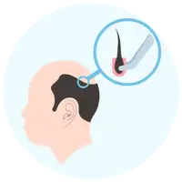 Hair transplant by Dr. Vishal Patel