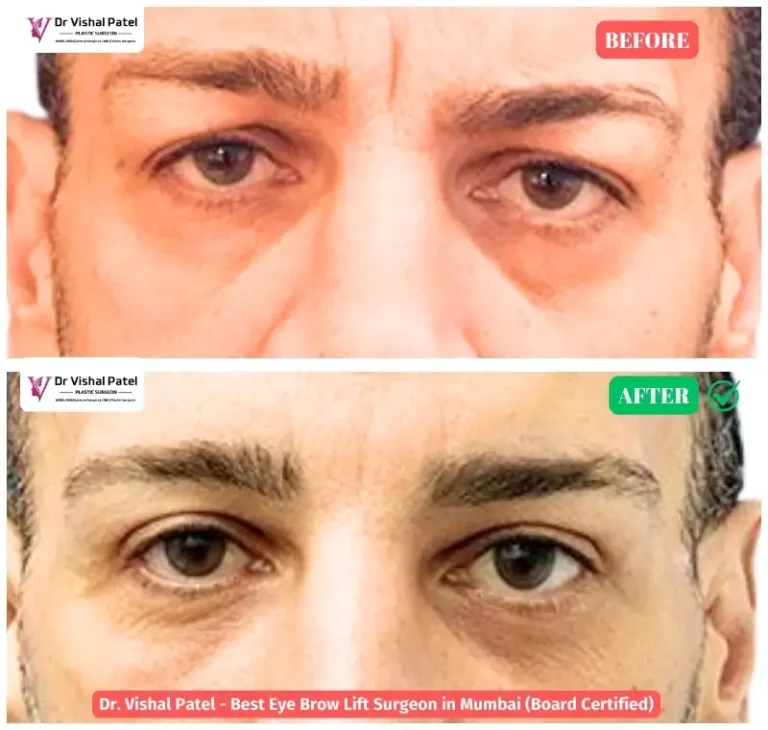 Indian Brow Lift Men - Before After Photo