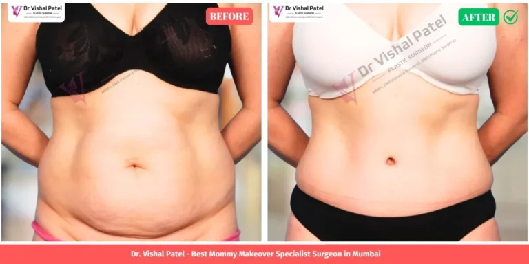 Indian Female Mommy Makeover Tummy Tuck Results - Before and After