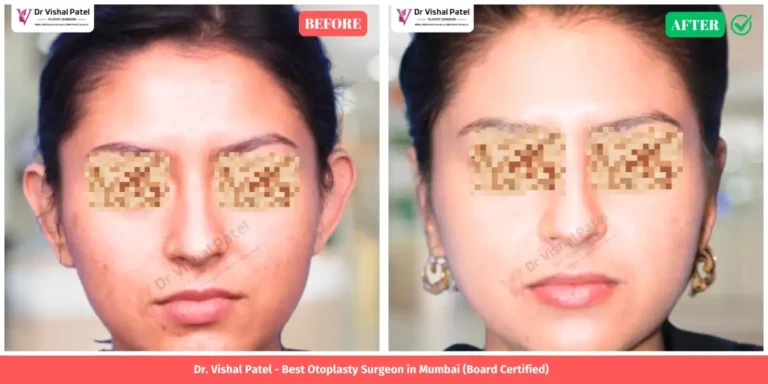 Indian Female Otoplasty Ear Shape Correction by Dr. Vishal Patel