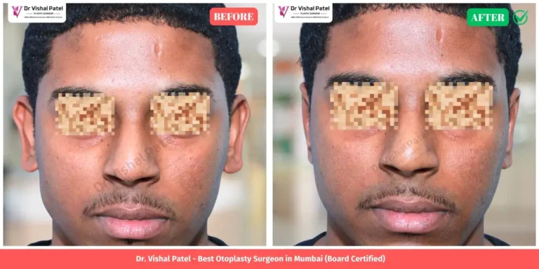 Indian Male Otoplasty Before and After Photo - by Dr. Vishal Patel