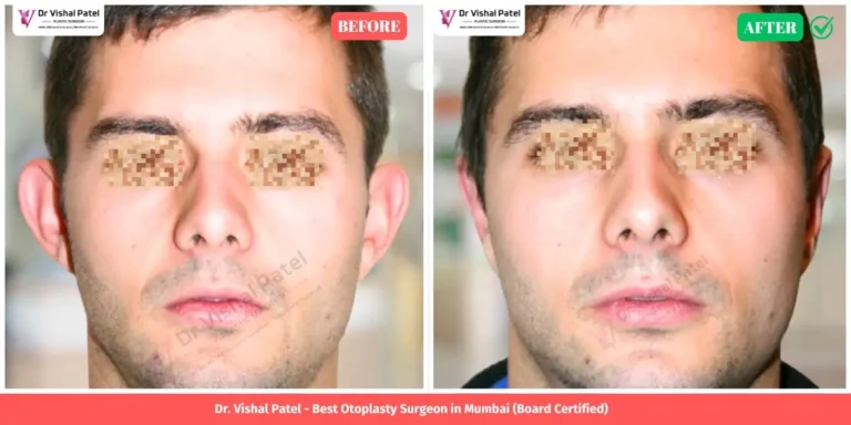 Indian Male Otoplasty Before and After Photo by Dr. Vishal Patel in Mumbai