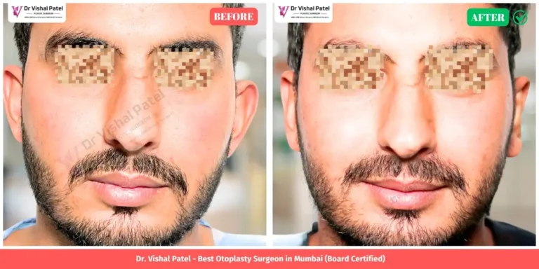 Indian Male Otoplasty Ear Shape Correction Before and After Photo - by Dr. Vishal Patel