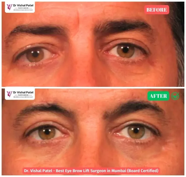 Indian Man Brow Lift Surgery Before and After by Dr. Vishal Patel