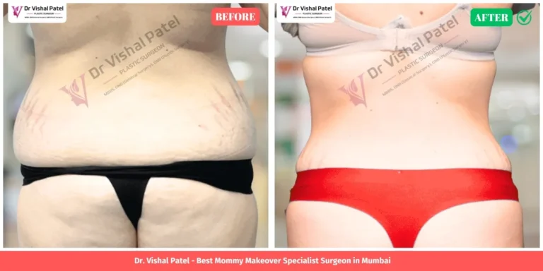Indian Women Mommy Makeover Before and After Photo