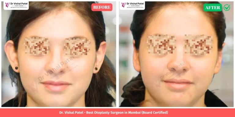 Indian young women Otoplasty Before and After Photo - by Dr. Vishal Patel