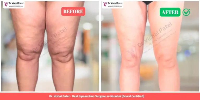 Inner Thigh Liposuction Before and After - Indian Female in Mumbai Andheri