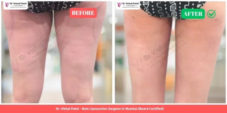 Inner Thigh Liposuction Before and After - Indian Female in Mumbai