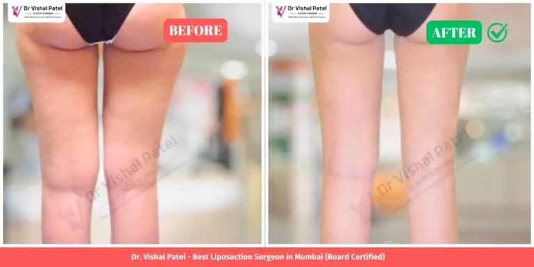 Inner Thigh Liposuction Before and After - Indian Female in Mumbai - Dr. Vishal Patel