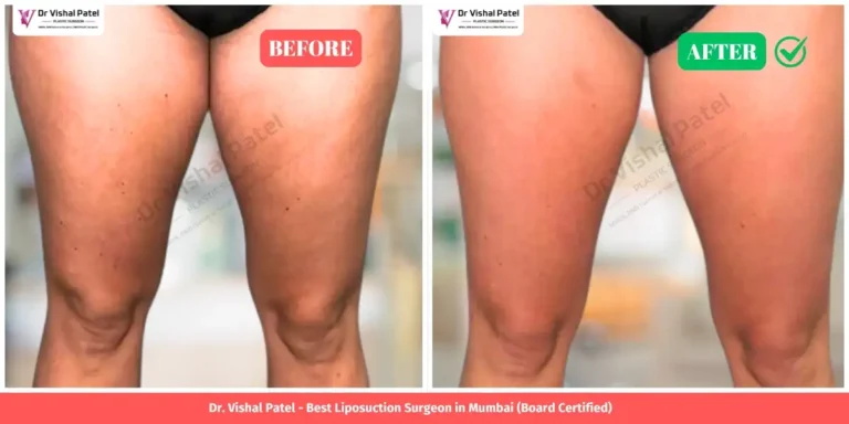 Inner Thigh Liposuction Before and After - Indian Female in Mumbai Malad