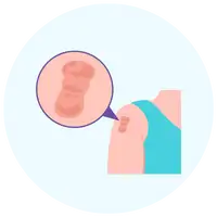 Keloid Treatment by Dr. Vishal Patel