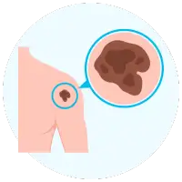Mole Wart Removal by Dr. Vishal Patel