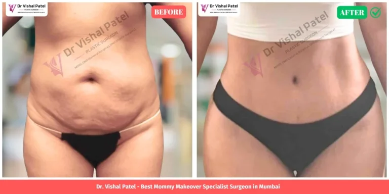 Mommy makeover in Mumbai India Before and after photo