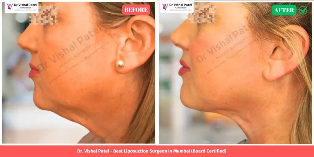 Neck Liposuction Before and After - Indian Female in Mumbai - Side View