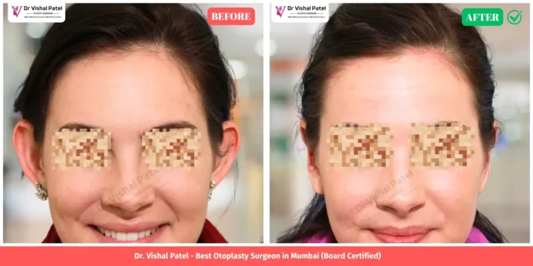 Otoplasty Ear Shape Correction Before and After Photo - Indian Female - by Dr. Vishal Patel