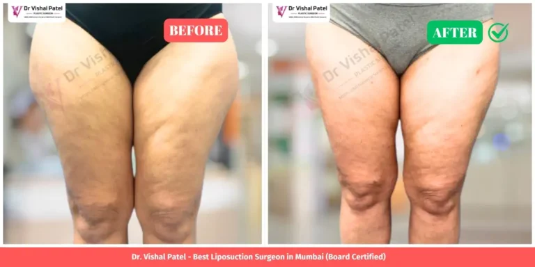 Outer Thigh Liposuction Before and After - Indian Female - by Dr. Vishal Patel in Malad