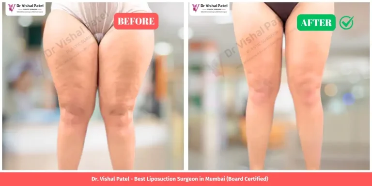Outer Thigh Liposuction in Mumbai - Before and After - Indian Female in Mumbai