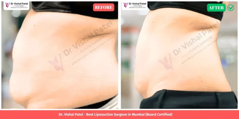 Stomach Liposuction Before and After - Indian Female in Mumbai - Left View