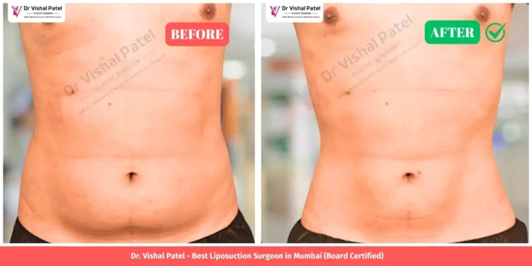 Stomach Liposuction Before and After - Indian Male - by Dr. Vishal Patel