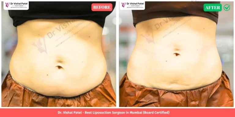 Stomach Tummy Liposuction Before and After - Indian Female in Mumbai - Front View