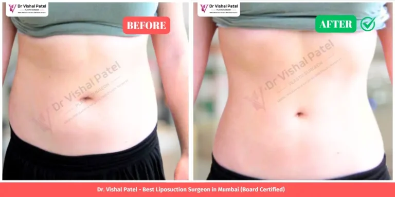 Tummy Liposuction Before and After - Indian Female - by Dr. Vishal Patel