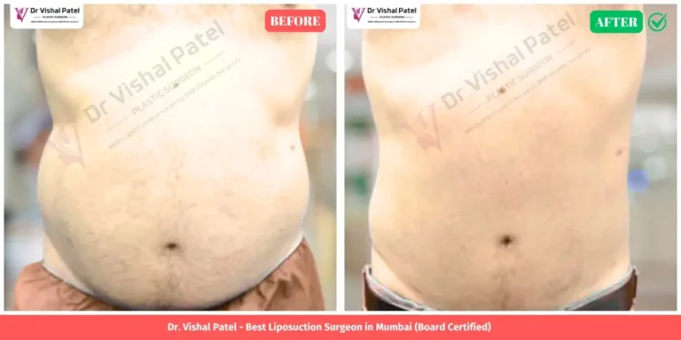 Tummy Liposuction Before and After - Indian Male in Mumbai - Front View